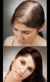 Imagen de trasplantes de pelo